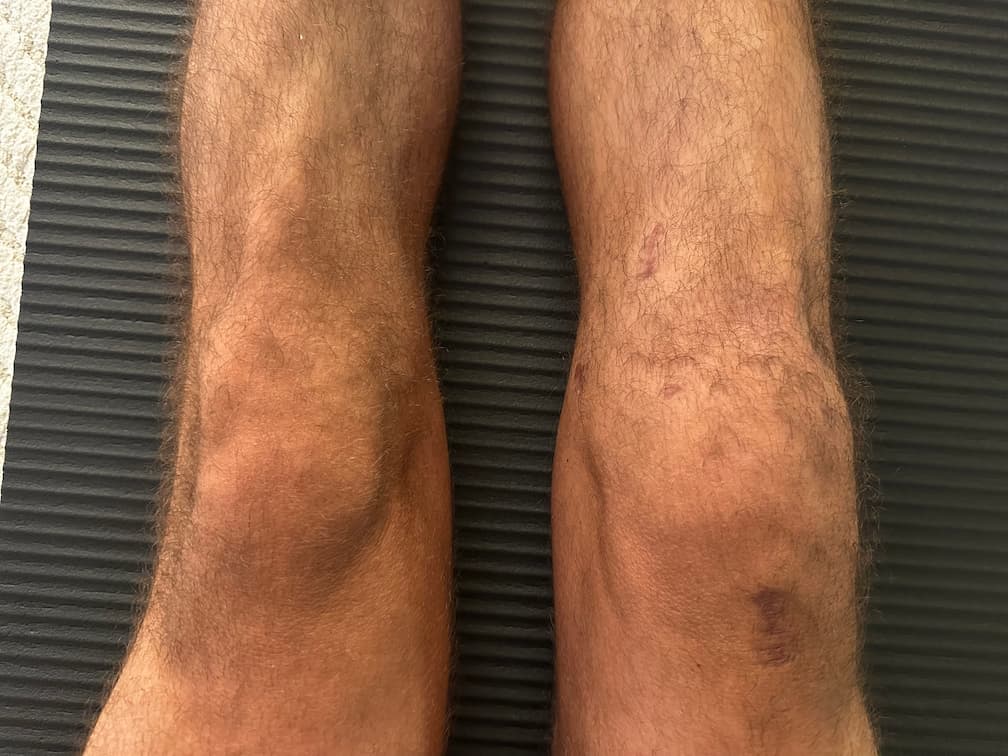 Dia 100 da recuperação do joelho