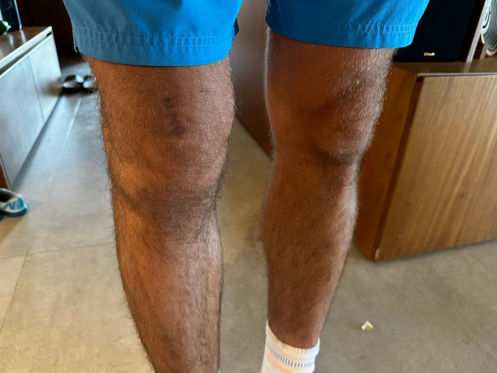 Dia 106 da recuperação do joelho