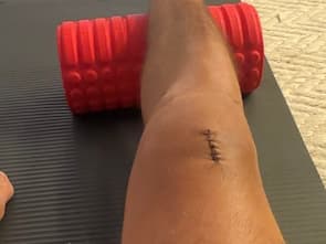 Foto do progresso no dia 11 da recuperação do joelho