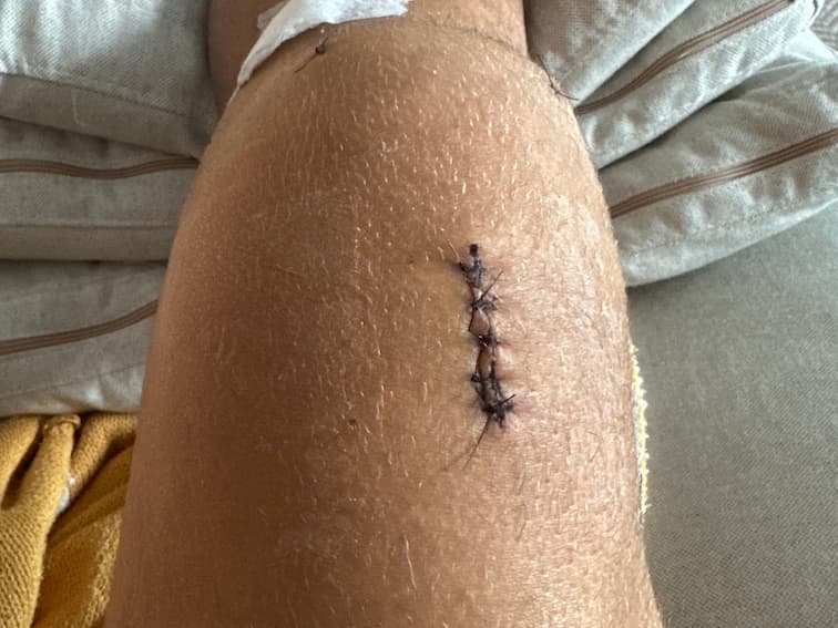 Foto do progresso no dia 16 da recuperação do joelho