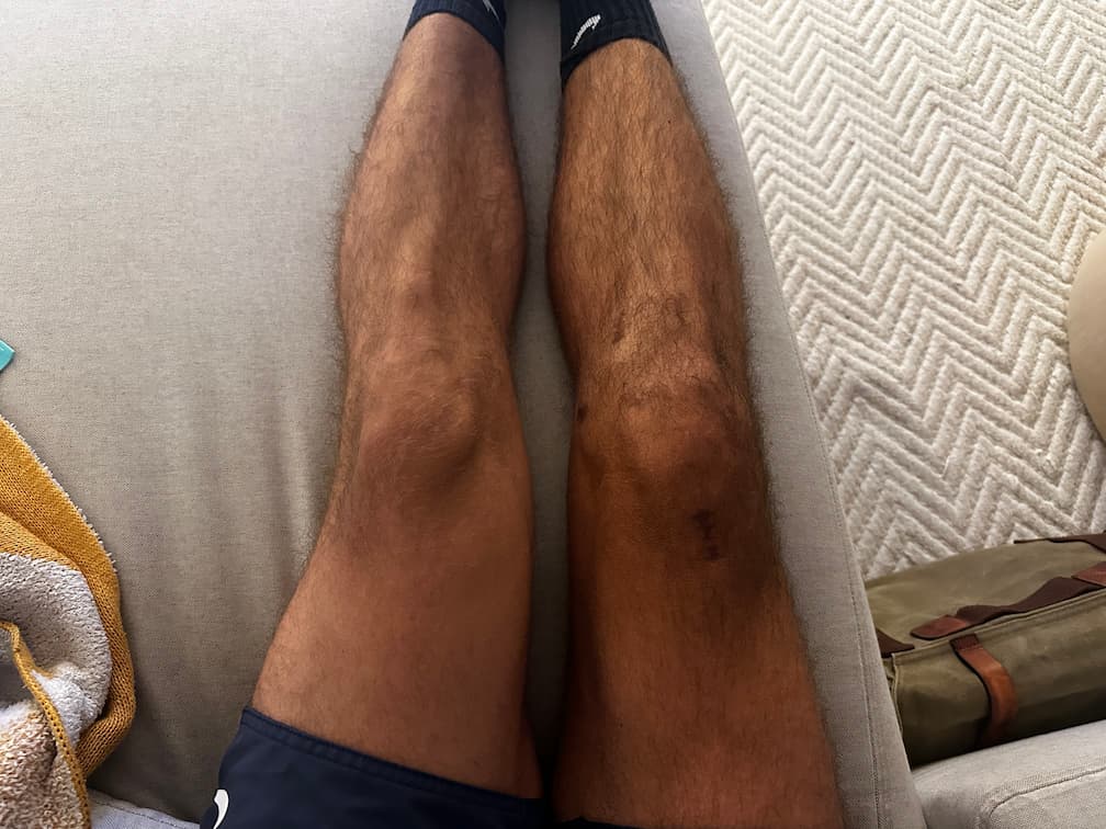 Dia 171 da recuperação do joelho