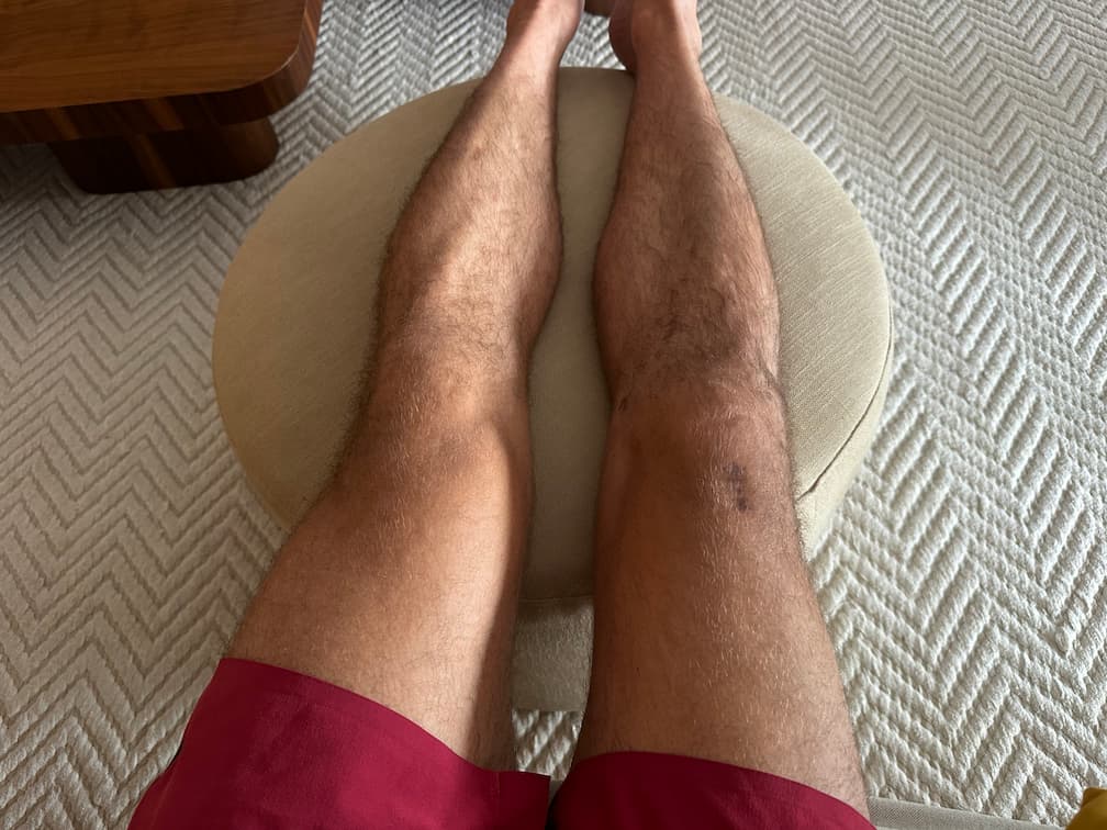 Dia 182 da recuperação do joelho